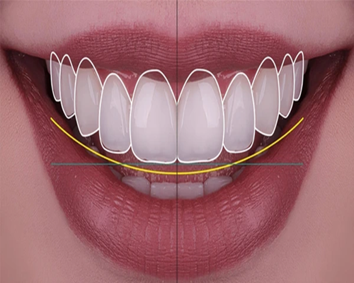 Dental Implant