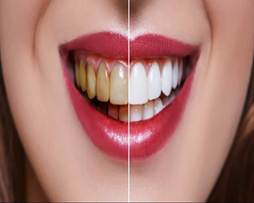 Teeth Whitening
