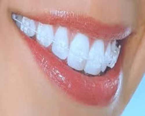 Dental Bridges
