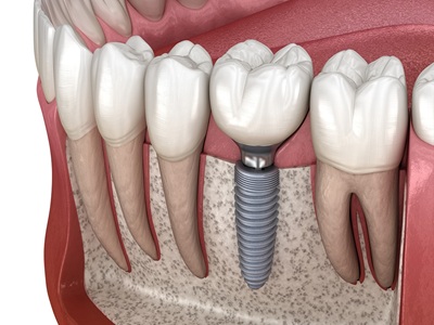 Dental Implant